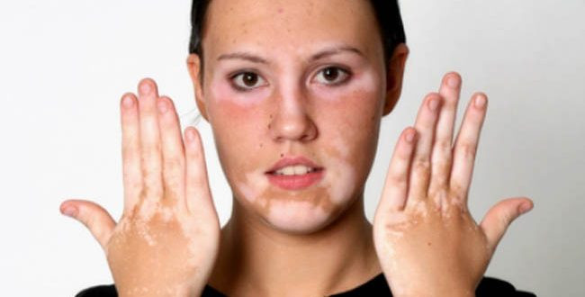 Cẩn thận với bệnh chưa có thuốc chữa, chẩn đoán dễ nhầm với ... giang mai 