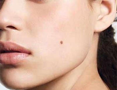 Ung thư từ nốt ruồi là loại rất nguy hiểm, phát triển nhanh, di căn nhanh, gây ung thư thứ phát ở gan, xương, phổi, não, hệ thống hạch...Ảnh minh hoạ: Internet