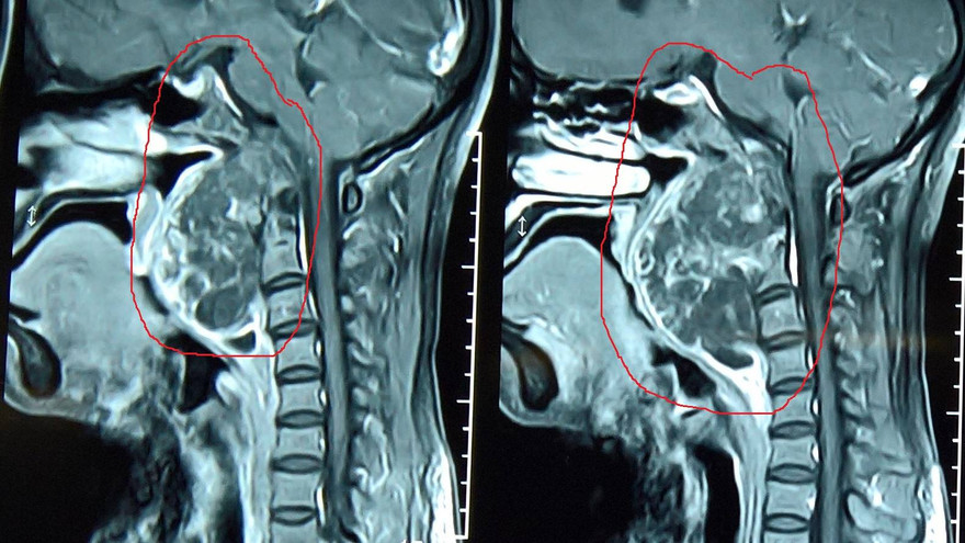 Khối u nằm vắt từ nền sọ xuống cột sống qua hình chụp x- quang. 