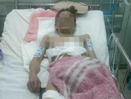 Cứu sống 1 phụ nữ bị rách bụng, ngực lộ toàn bộ nội tạng