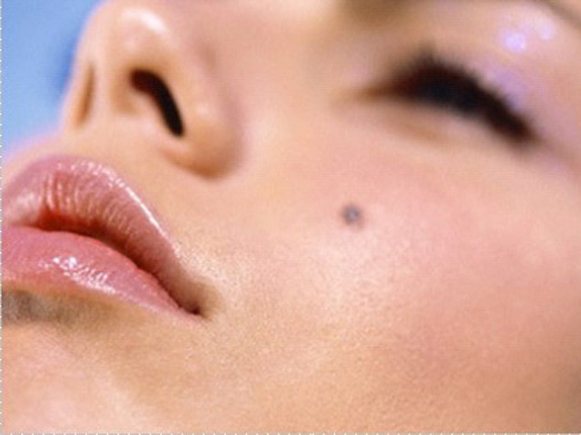 Nhiều người bị ung thư da mà không hề hay biết hoặc lầm tưởng đó chỉ là "nốt ruồi" hoặc mảng da, bớt bình thường . Ảnh minh hoạ: Internet