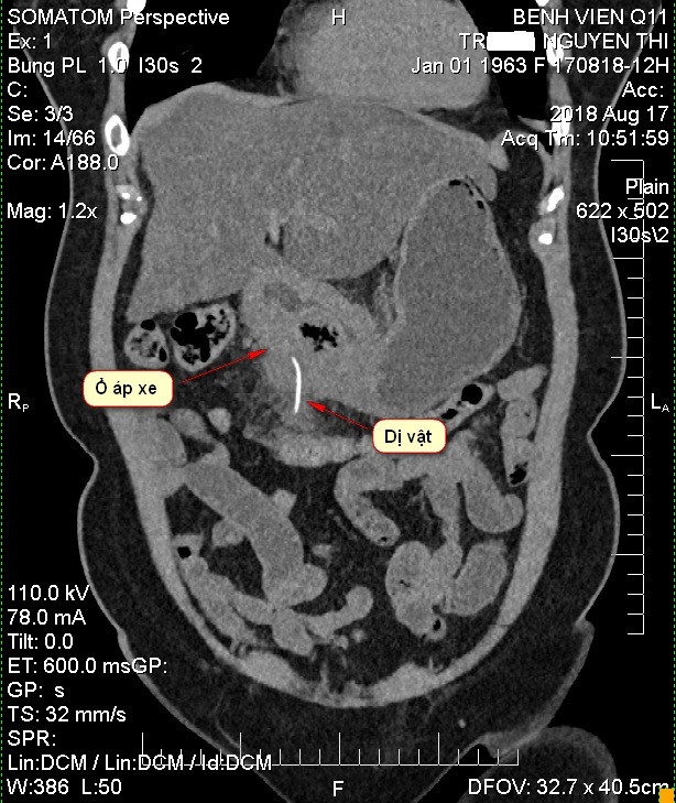 Bệnh nhân suýt chết vì xương cá dài 5cm đâm thủng dạ dày 