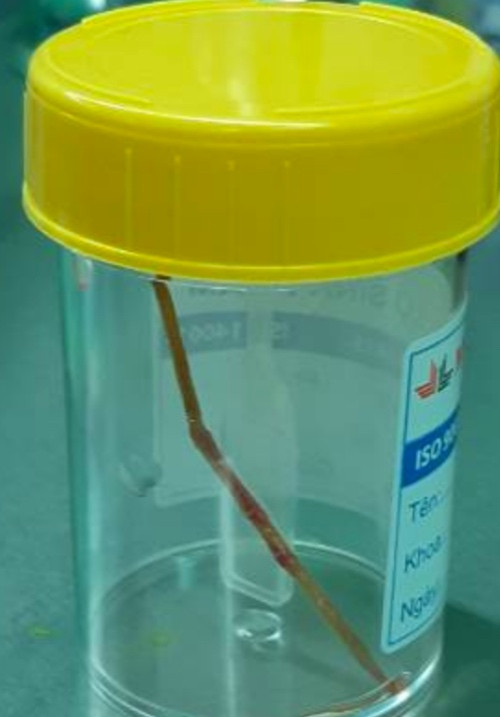 Tăm xỉa răng dài 6cm đâm thủng ruột bé trai 14 tuổi