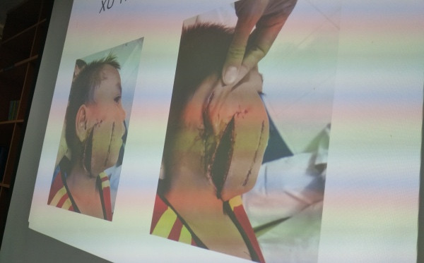 Quạt công nghiệp 'chém' nát mặt bé trai 6 tuổi