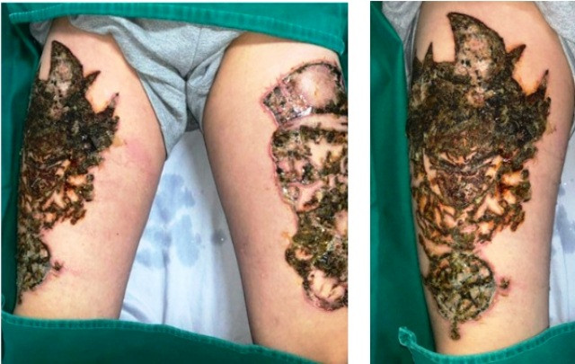 Hình ảnh tổn thương mụn nước, vết trợt và nhiều vảy tiết đen trên vùng da đùi 2 bên sau xóa xăm 4 ngày. Ảnh: Bệnh viện cung cấp