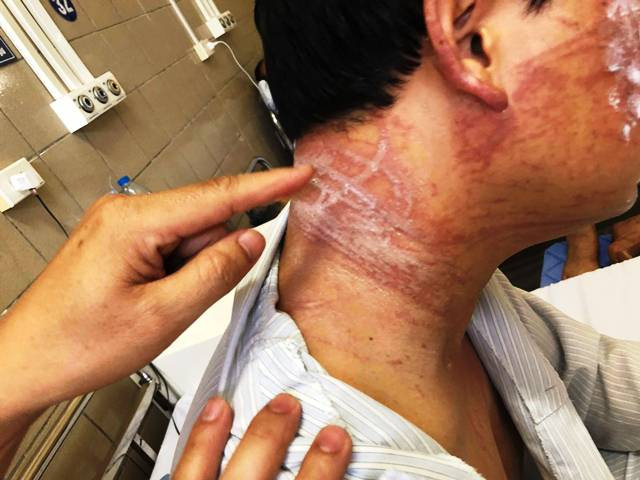 Các vết thương vẫn chằng chịt trên cơ thể người đàn ông sau 10 ngày bị sứa tấn công.