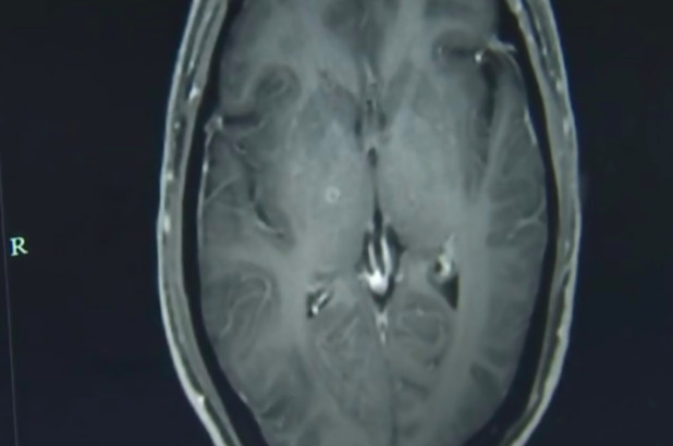 Hình ảnh chụp não cho thấy có hàng trăm con sán cư trú tại đó.