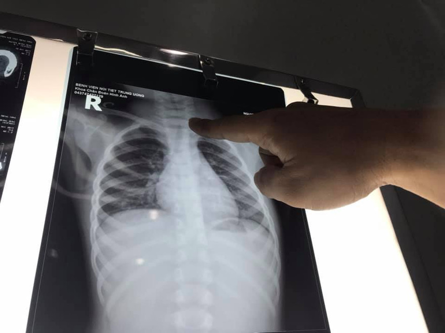 Phim chụp Xquang phổi của bé D