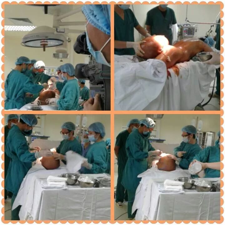 Ca mổ khối u khủng lồ cho bệnh nhân Quý (Ảnh: BV Ung bướu Hà Nội)