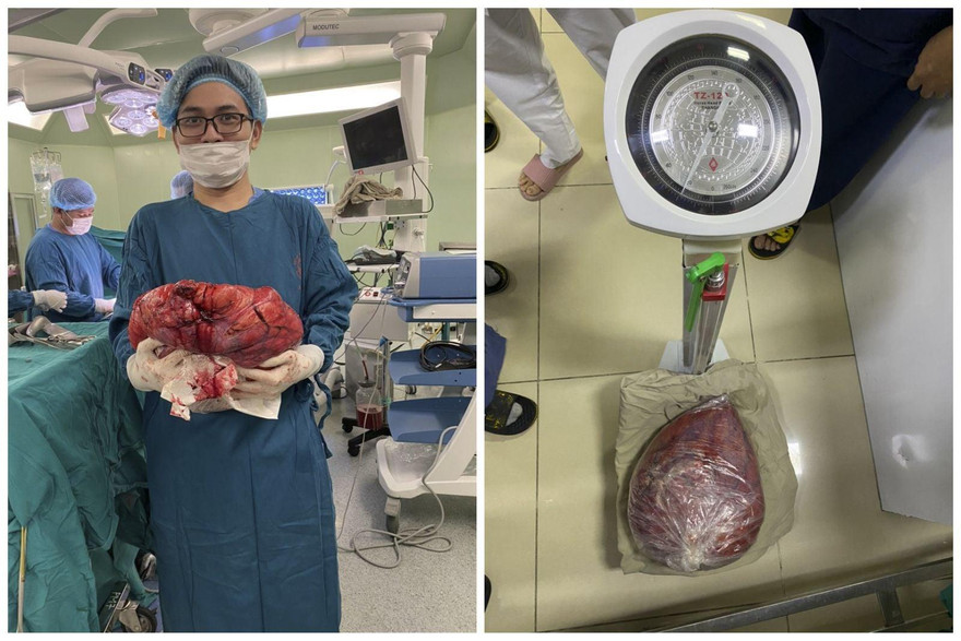 Khối u nặng 10 kg sau khi được phẫu thuật lấy ra khỏi ổ bụng bệnh nhân. Ảnh: BV cung cấp