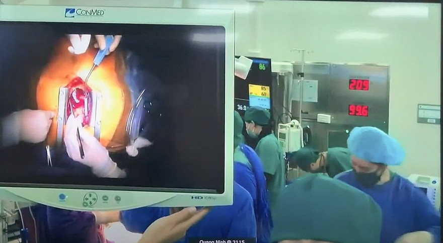 Với sự hỗ trợ từ xa của các chuyên gia BV Việt Đức, các thầy thuốc BVĐK Quảng Ninh đã thực hiện thành công ca phẫu thuật cấp cứu, cứu sống bệnh nhân nguy kịch sau khi bị tai nạn. Ảnh: BV Việt Đức cung cấp