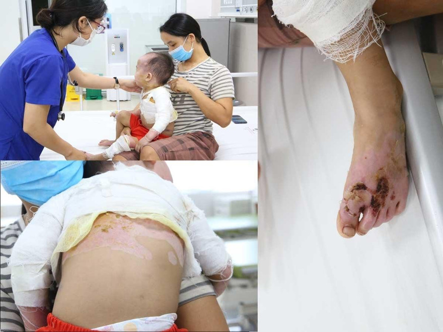 Các vị trí vết bỏng sâu nghiêm trọng của trẻ. Ảnh: BS cung cấp