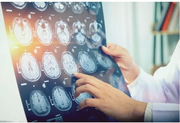 Các chuyên gia đã chụp bộ náo các bệnh nhân căn bệnh bí ẩn này để tìm nguyên nhân.