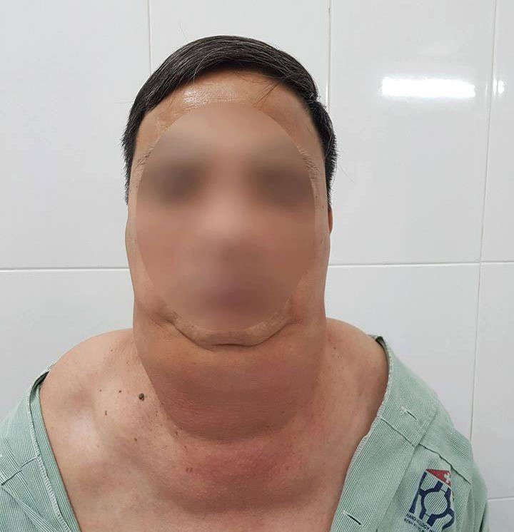 Bệnh nhân với khối u khi chưa được phẫu thuật. Ảnh: Bệnh viện Ung bướu Hà Nội cung cấp