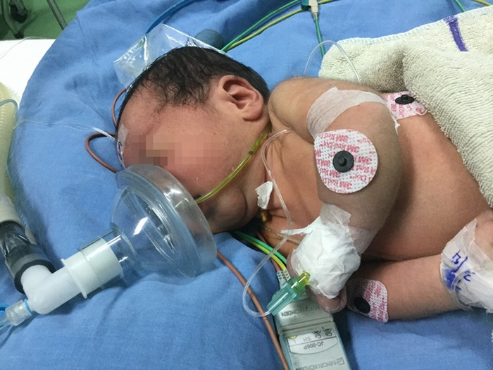 Sau ca phẫu thuật kéo dài hơn 2 tiếng, bệnh nhi đã không còn phải thở máy Ảnh BVCC