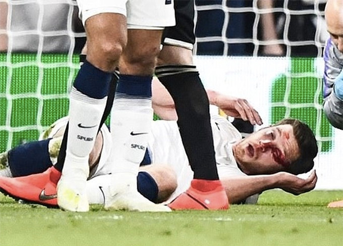 Jan Vertonghen chấn thương sau pha va chạm với đồng đội.