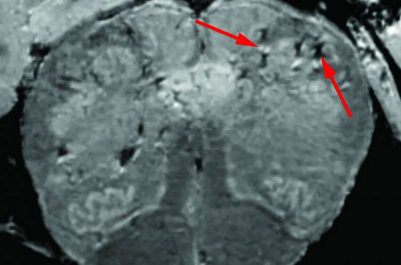 Các nhà khoa học nghiên cứu cơ chế virus SARS-CoV-2 xâm nhập vào đầu.