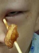 Hai trẻ bị … que xiên thức ăn chọc thủng mắt