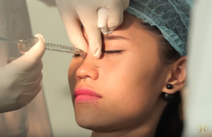 Tiêm filler tại spa, một thiếu nữ bị tổn thương thị lực