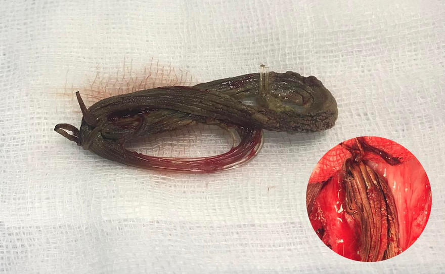 Lấy cuộn cước câu 'ở' trong niệu đạo nam thanh niên 11 năm