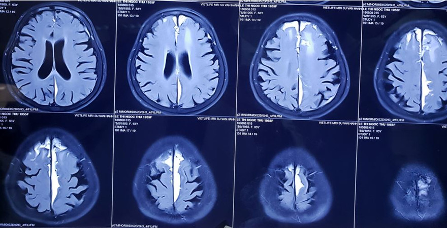 Bệnh nhân 71 tuổi đã hết liệt chân sau khi phẫu thật não bằng gây tê