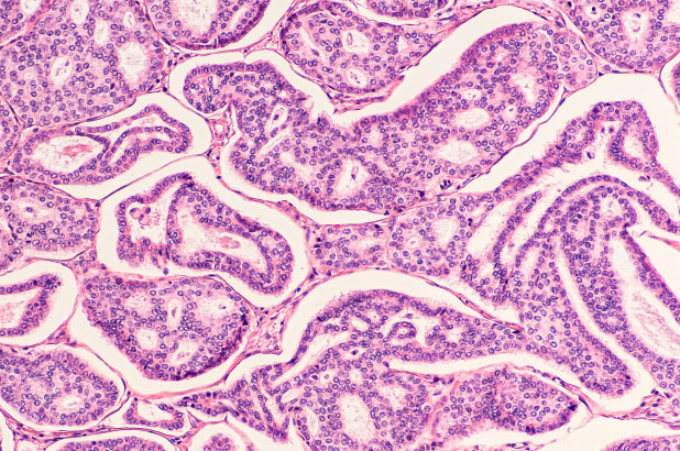 Trí tuệ nhân tạo có thể chẩn đoán ung thư vú chính xác tới 99%.