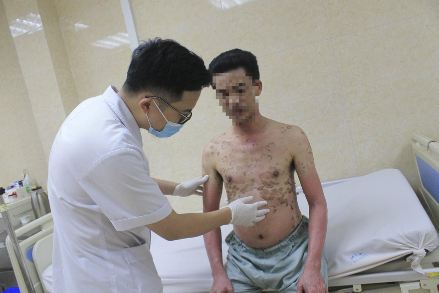 BS thăm khám cho bệnh nhân mắc dị ứng thuốc cực nặng. Ảnh: BS cung cấp