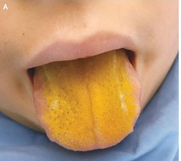 Lưỡi cậu bé bỗng chuyển màu vàng tươi.