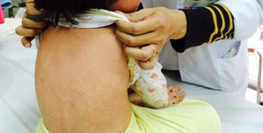 Trẻ bị sởi đang được điều trị tại bệnh viện. Ảnh: Internet