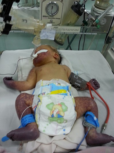 Bệnh nhi khi nhập viện. Ảnh: Ths.BS Phạm Thị Thanh Tâm, Trưởng khoa Hồi sức sơ sinh, BV nhi đồng 1.