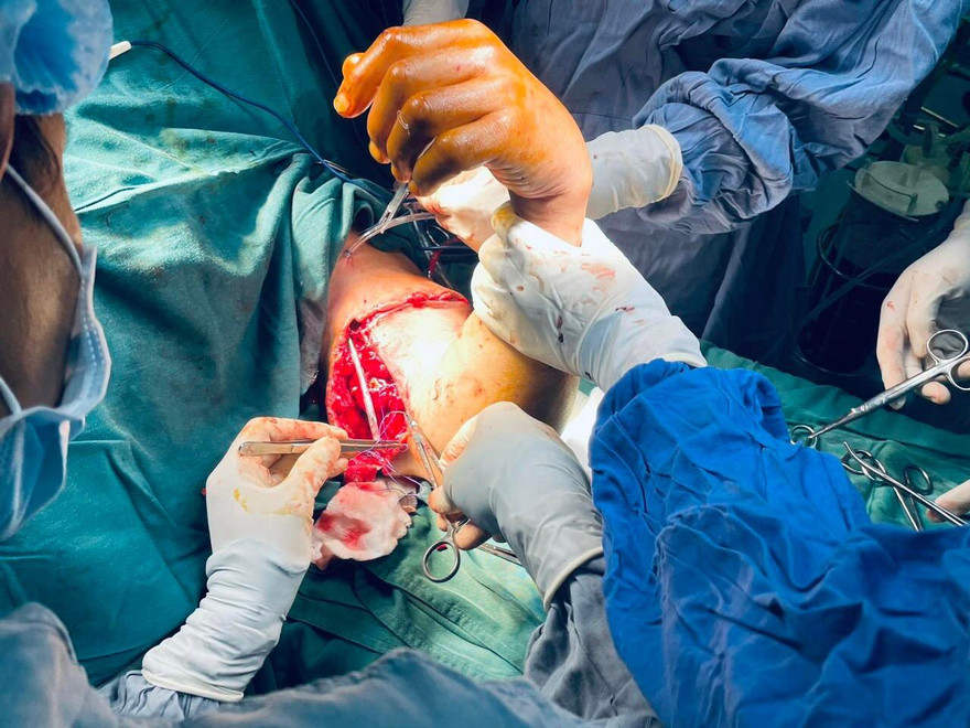 Nối thành công cánh tay bị đứt lìa