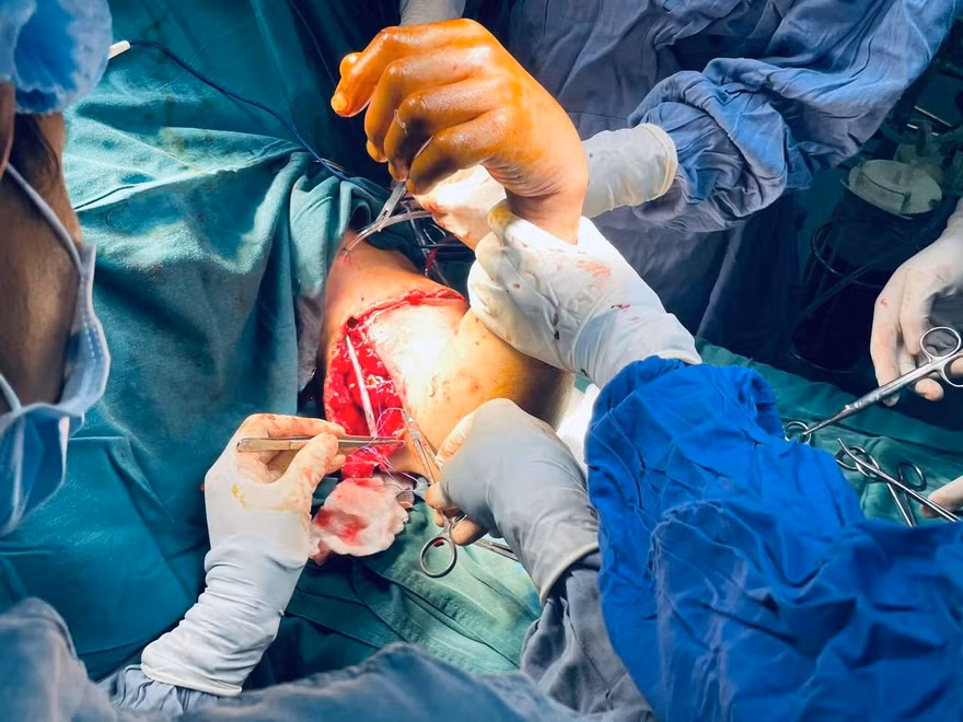 Nối thành công cánh tay bị đứt lìa