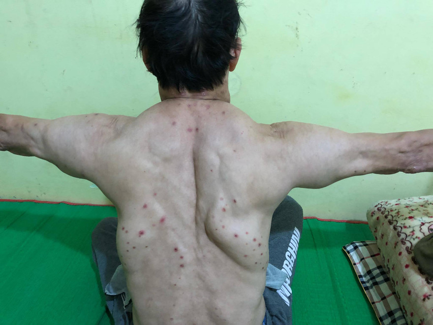 Người đàn ông với những khối u lạ mọc chi chít khắp người. Ảnh: BV cung cấp