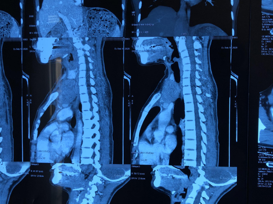 Hình ảnh phim chụp khối u tuyến ức lạc chỗ