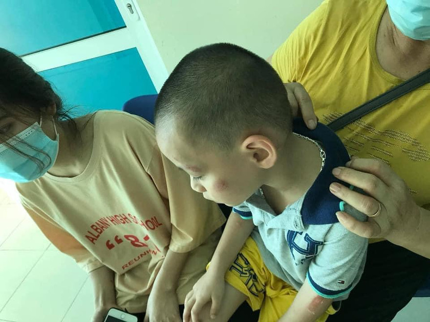 Trong số nhiều người bị chó cắn, có cả em bé bị tấn công vào má, tay rất nguy hiểm. - Ảnh: TL