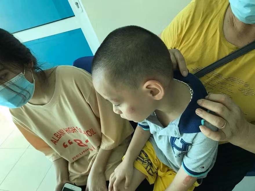 Trong số nhiều người bị chó cắn, có cả em bé bị tấn công vào má, tay rất nguy hiểm. - Ảnh: TL