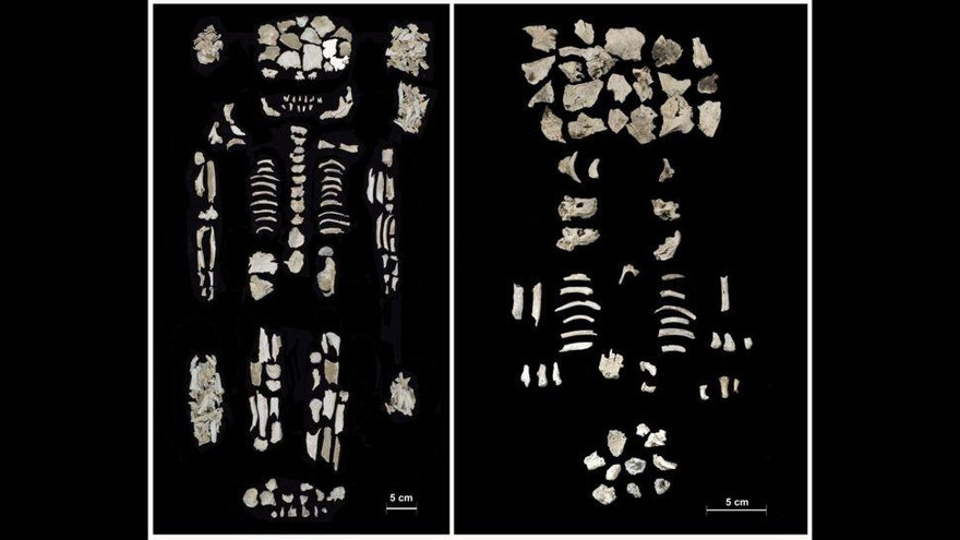 Bộ xương người mẹ ( bên trái) và cặp song sinh,