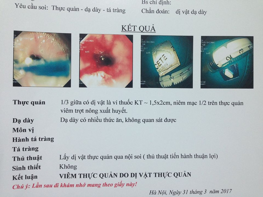 Hình ảnh viên thuốc còn nguyên vỏ bọc trong thực quản bệnh nhân