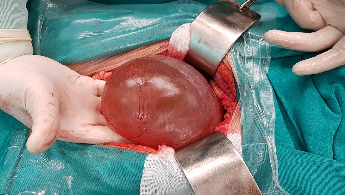 U được lấy khỏi bệnh nhân u nang bạch huyết. 