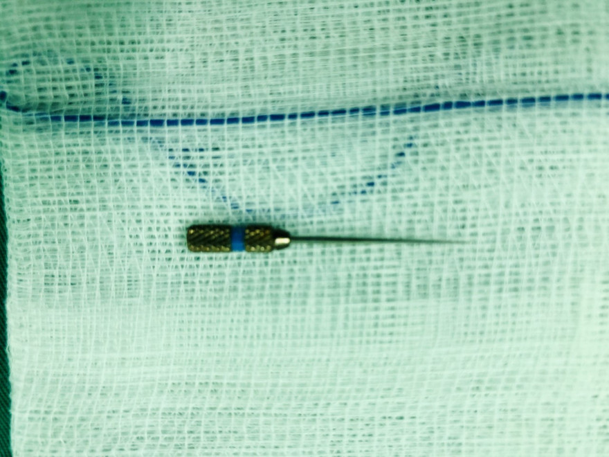 Kim nha khoa dài 4cm được các bác sĩ lấy ra thành công