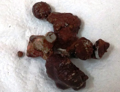 Ảnh: Viên sỏi thận giống hệt san hô biển