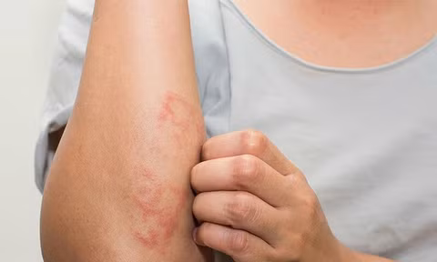 Nổi mẩn tưởng dị ứng thông thường, trẻ gặp nguy cơ tổn thương thận