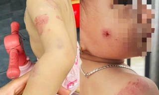 Phụ huynh bức xúc khi con gái hơn 2 tuổi chi chít vết cắn trên người sau giờ học 