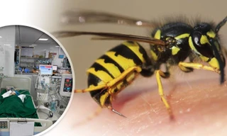 Bé gái 9 tuổi nguy kịch vì bị đàn ong vò vẽ đốt hơn 50 nốt