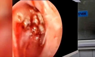 Dòi đóng ổ trong mũi người phụ nữ