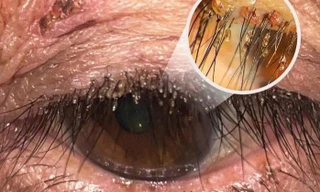 Phát hiện rận mu ký sinh dày đặc trên lông mi người phụ nữ