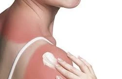 Nắng nóng cực điểm: Cảnh báo bỏng nắng và bệnh da tăng cao