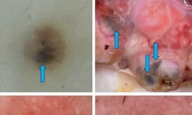 Tưởng nốt ruồi, hóa ra ung thư tế bào đáy