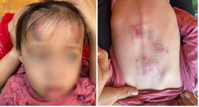 Những vết bầm tím của bé gái bị đánh ở lớp mầm non đăng tải trên mạng xã hội. 