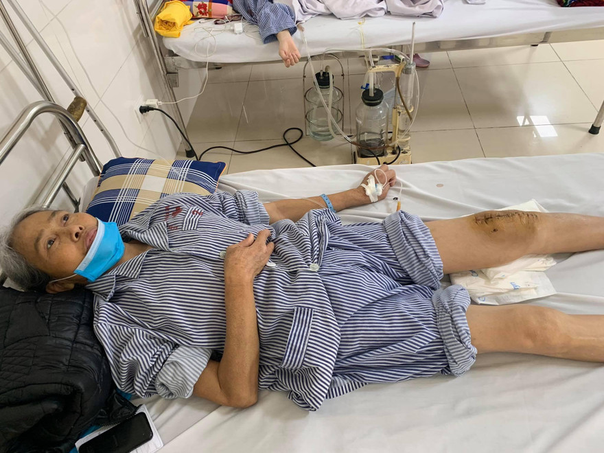 Đột phá: Lần đầu tiên thay khớp gối nhân tạo cho người mắc lao khớp gối